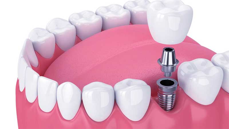 The Ultimate Guide to the Cost of a Dental Implants